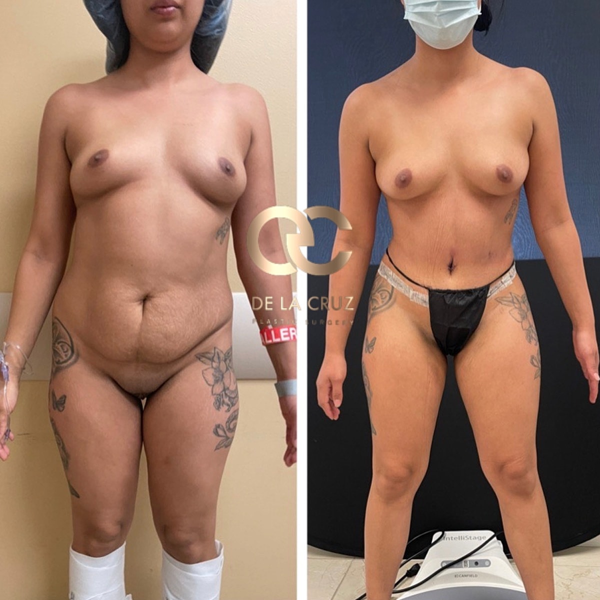 Abdominoplasty results Houston TX