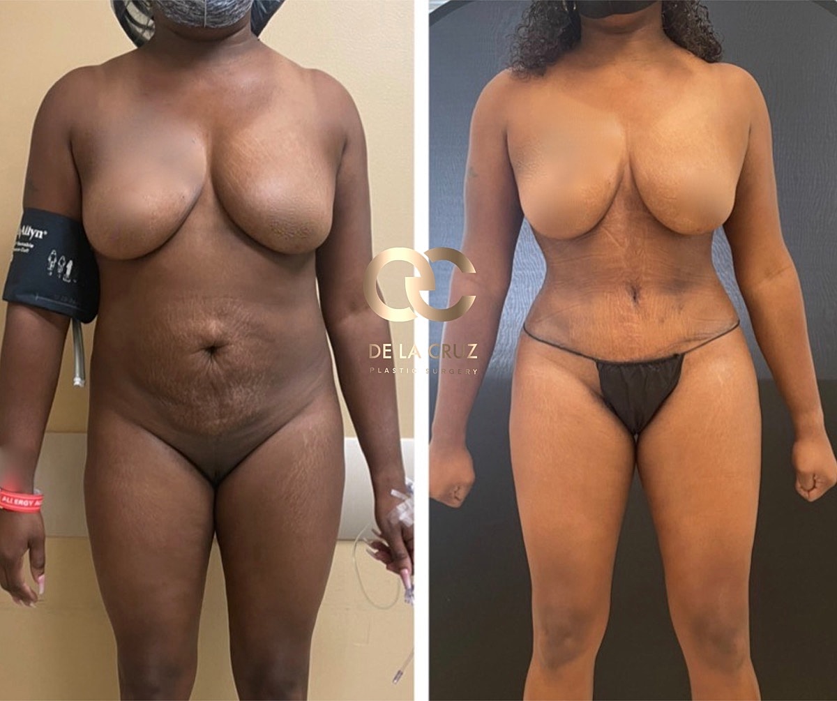 Houston abdominoplasty results