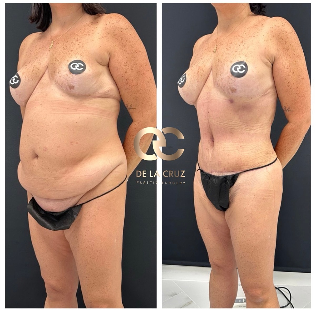 Houston tummy tuck results demonstrating abdominal muscle repair and contour refinement.