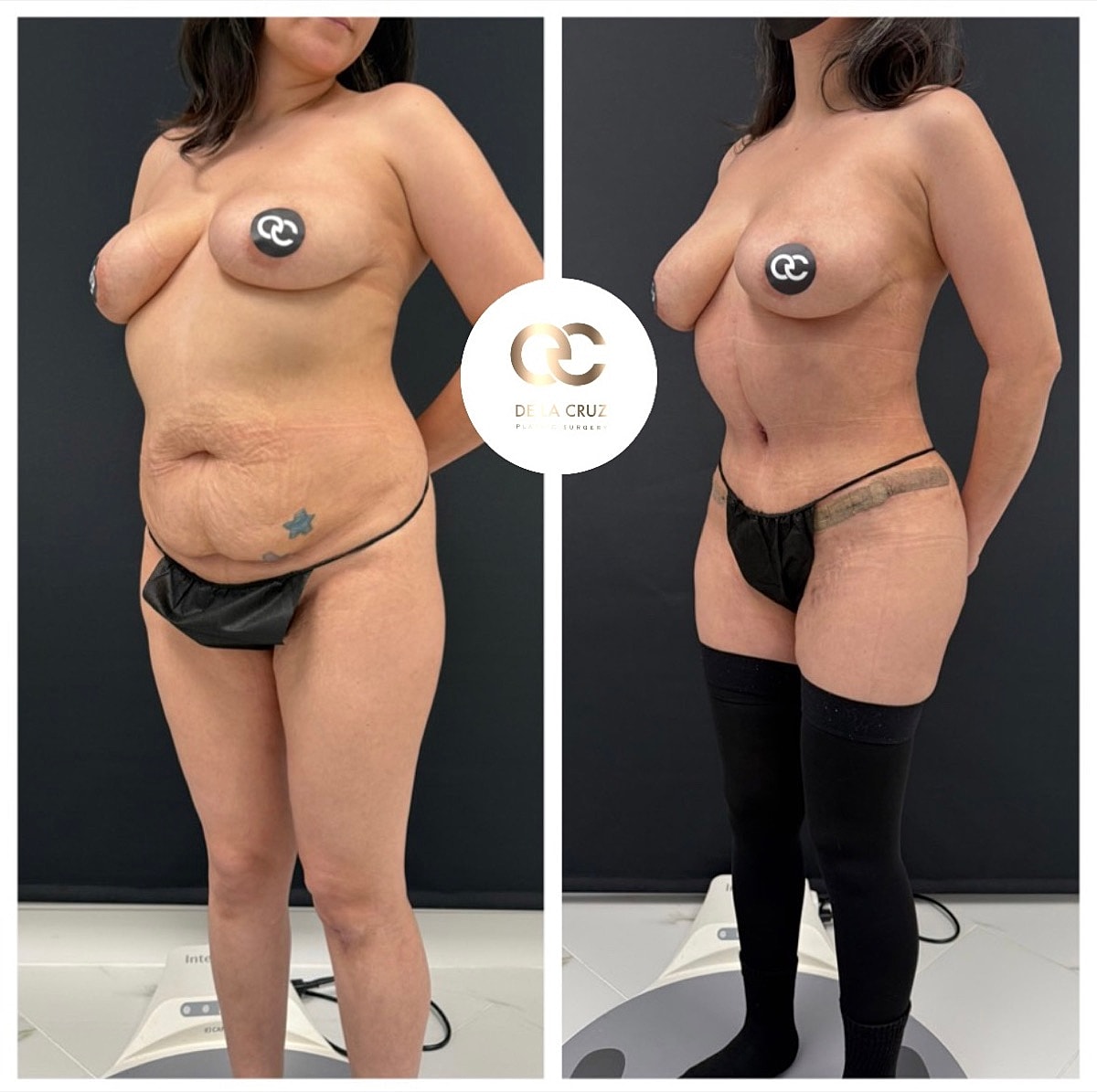 tummy tuck before and after Houston