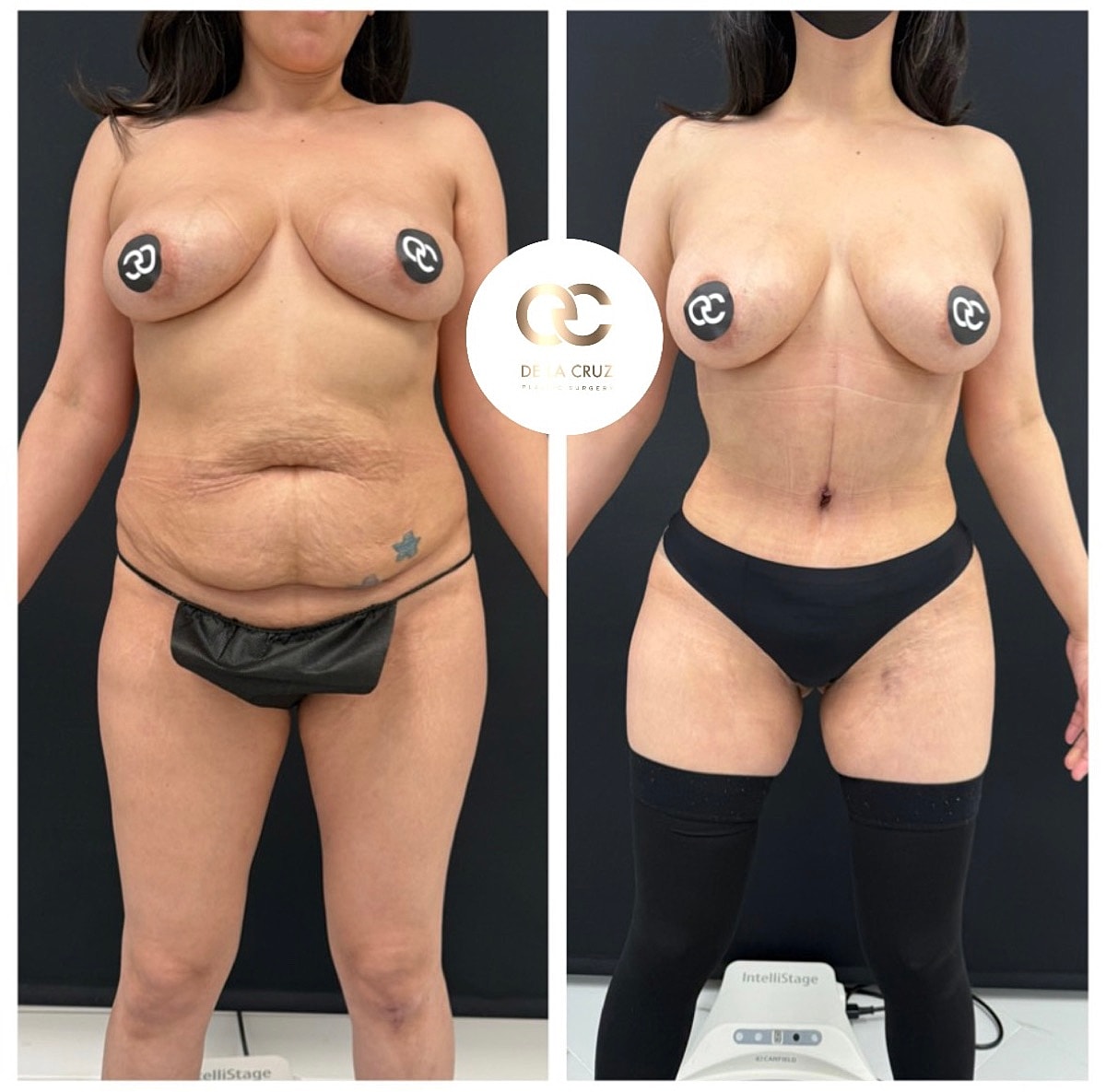tummy tuck before and after Houston