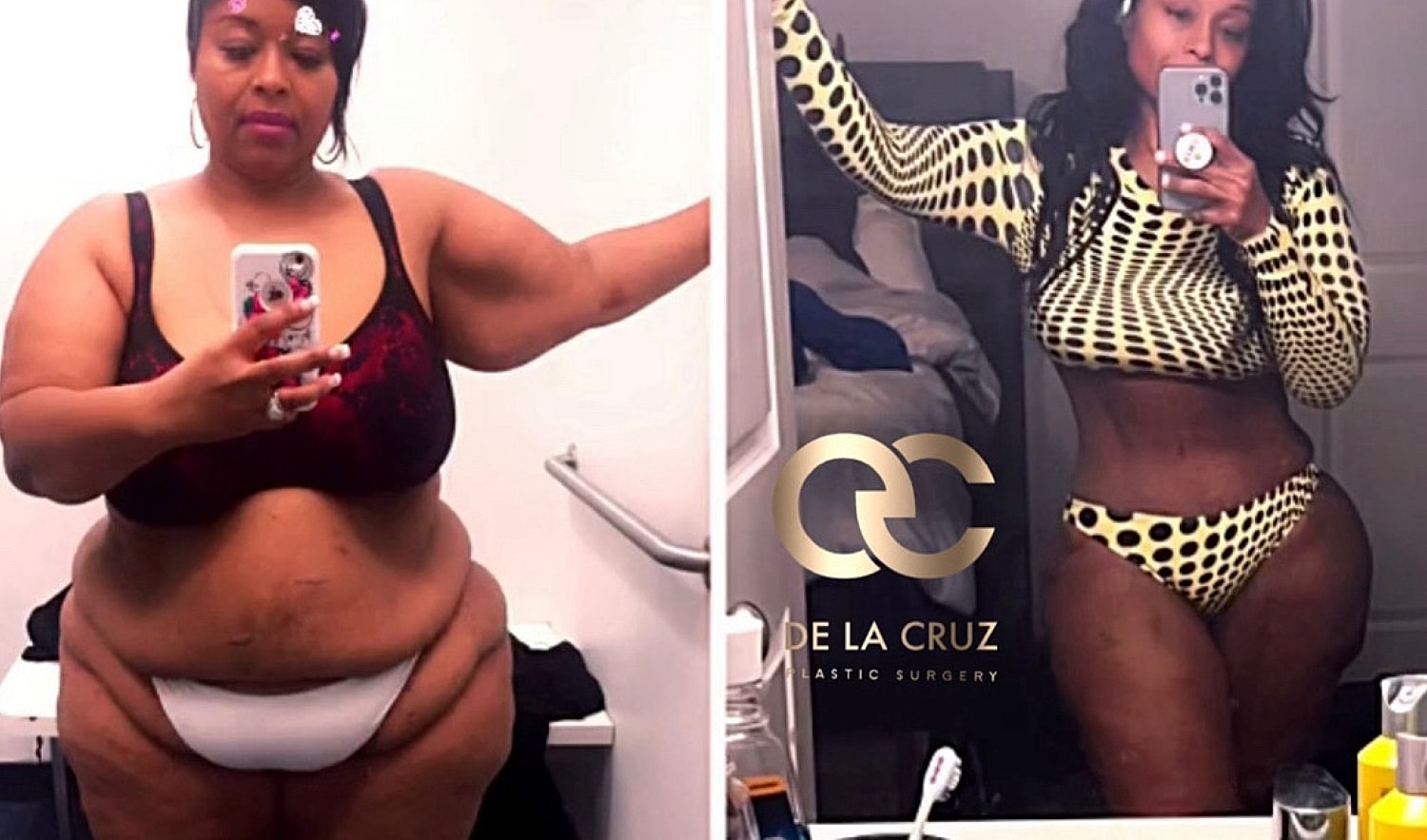 Liposuction Results Houston TX